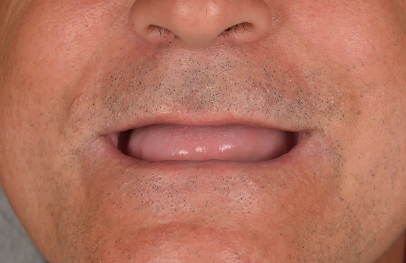 Ambele arcade fără dinți, refăcute cu lucrări fixe pe implanturi, înainte de tratament