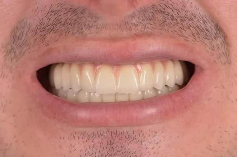 Lucrare fixă sprijinită pe 6 implanturi dentare, după tratament