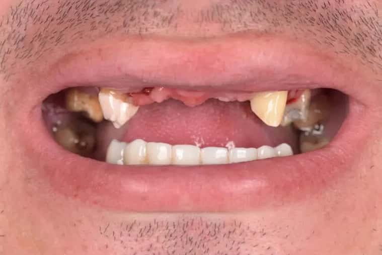 Lucrare fixă sprijinită pe 6 implanturi dentare, înainte de tratament