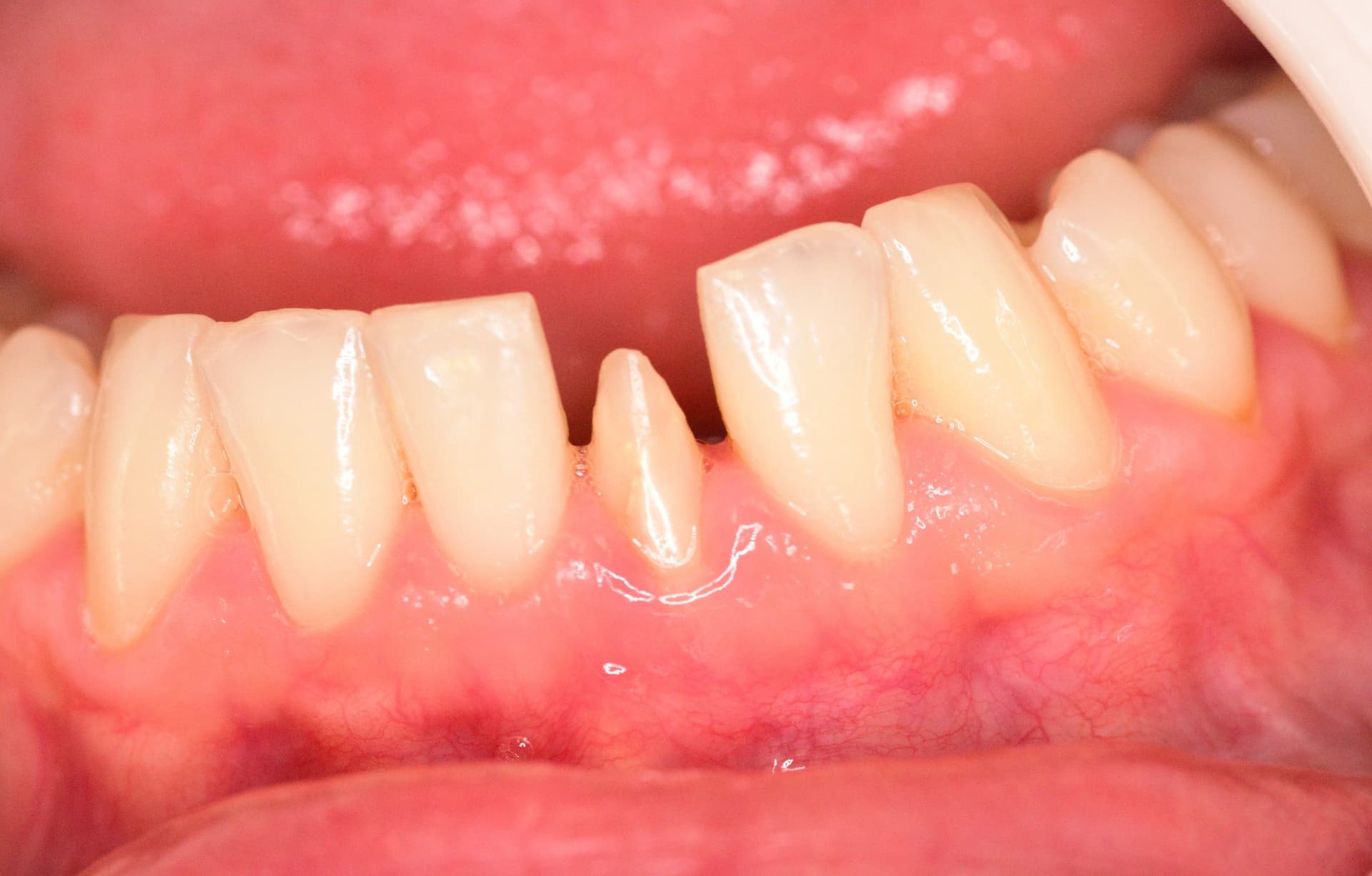 Coroană ceramică pe dinte frontal inferior, înainte de tratament