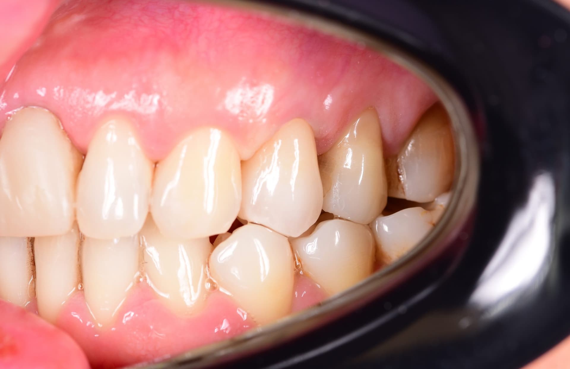 Coroană ceramică pe dinte lateral superior, după tratament