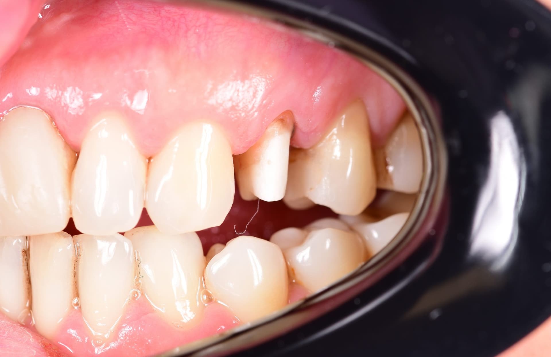 Coroană ceramică pe dinte lateral superior, înainte de tratament