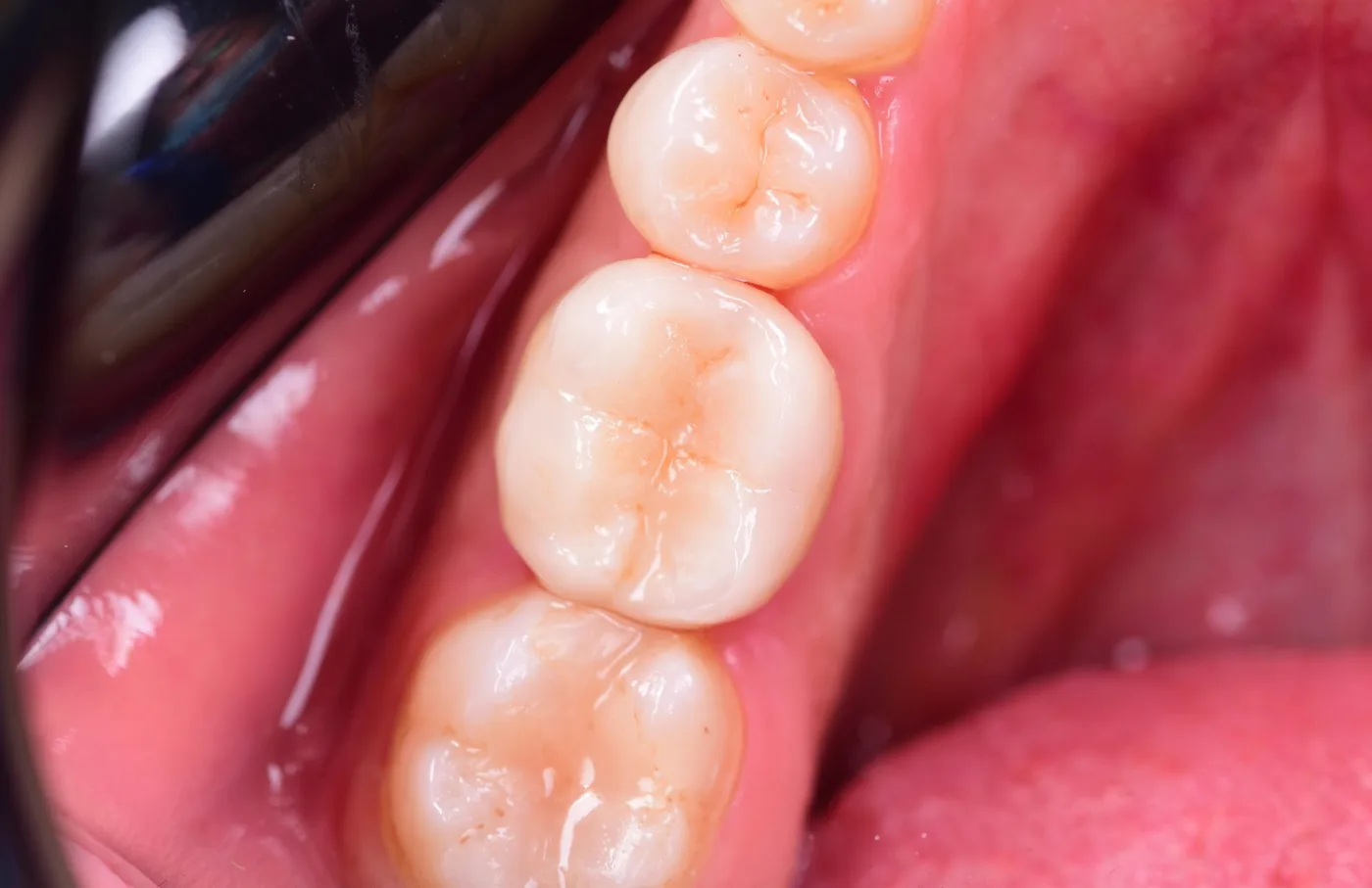 Coroană integral ceramică E-max montată pe un molar