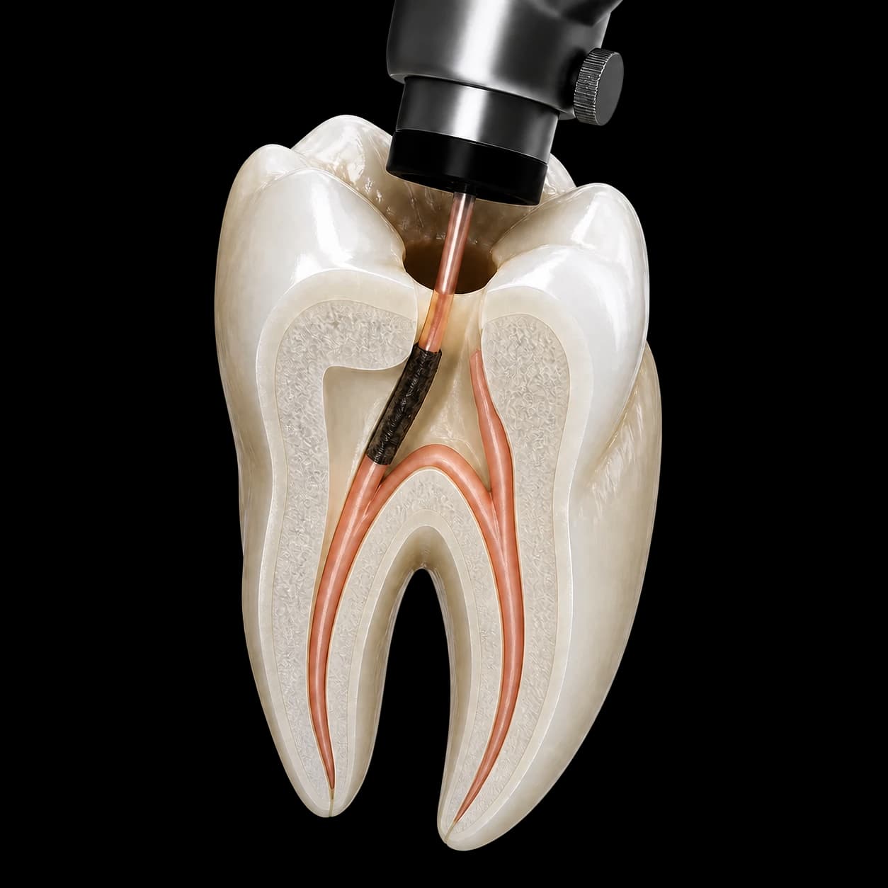 Molar în secțiune în timpul unui retratament endodontic la microscop