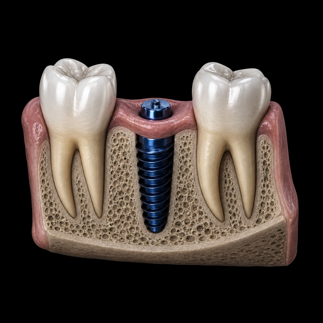 Implant dentar integrat în osul vindecat dintre doi dinți naturali