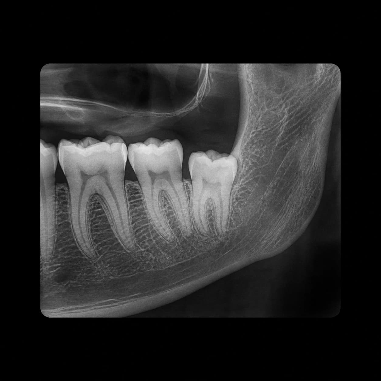 Radiografie cu un molar de minte erupt complet, cu rădăcinile vizibile