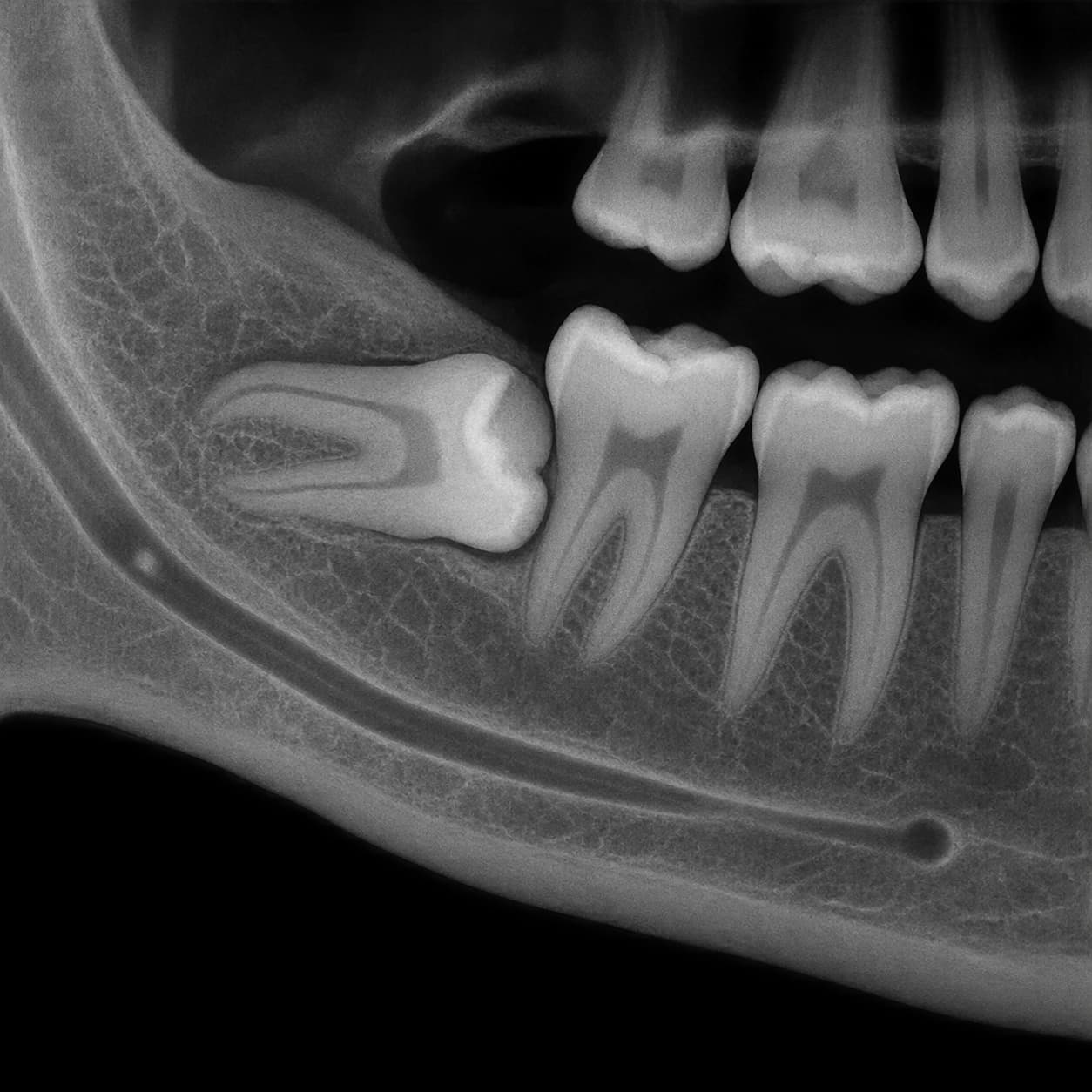Radiografie cu un molar de minte inclus în os, înclinat spre molarul vecin