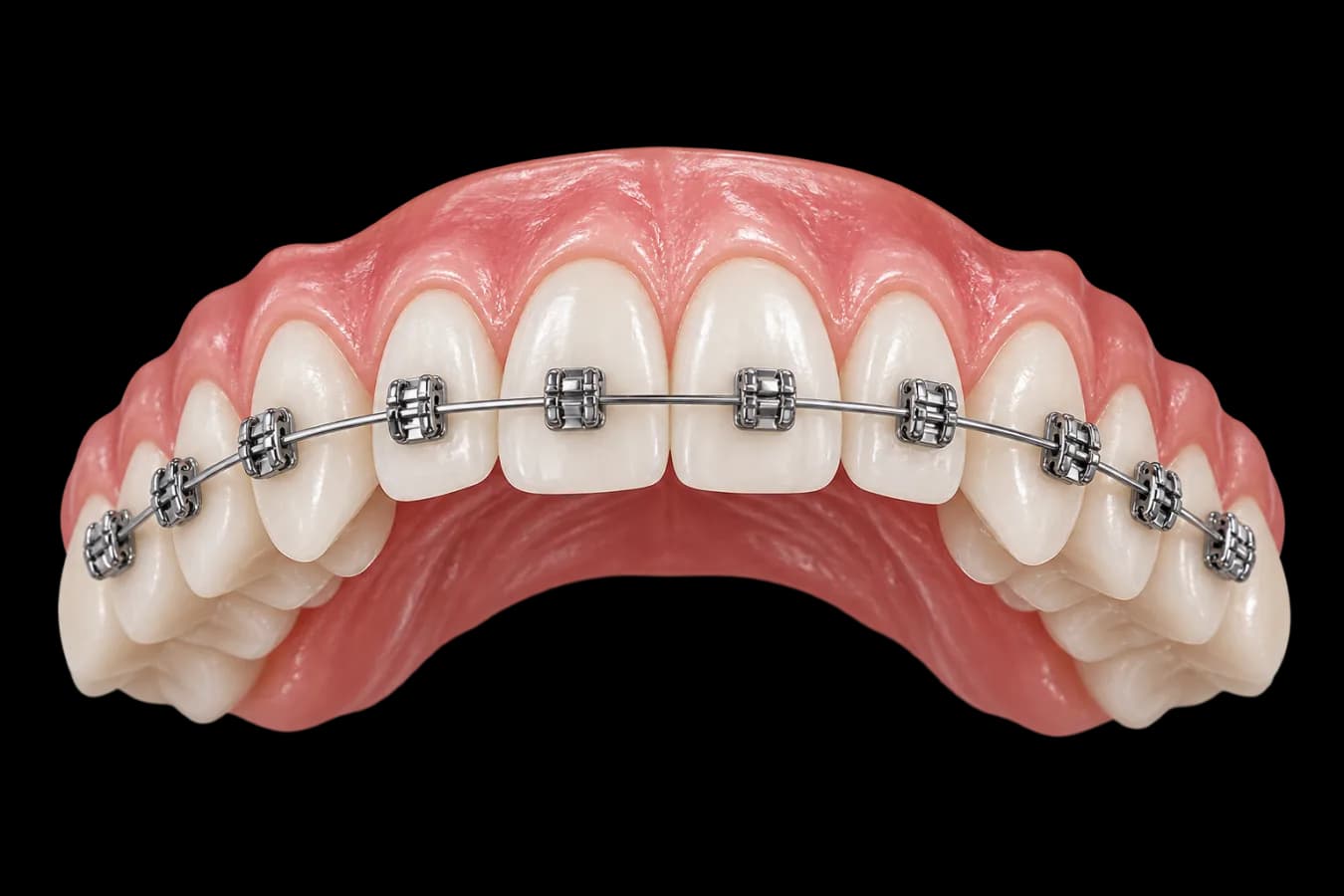 Aparat dentar fix cu bracketuri metalice