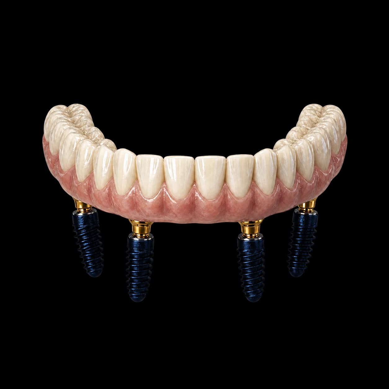 Lucrare dentară fixă All-on susținută de patru implanturi
